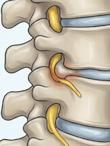 Principle of spinal space restoration relieving nerve compression in herniated discs